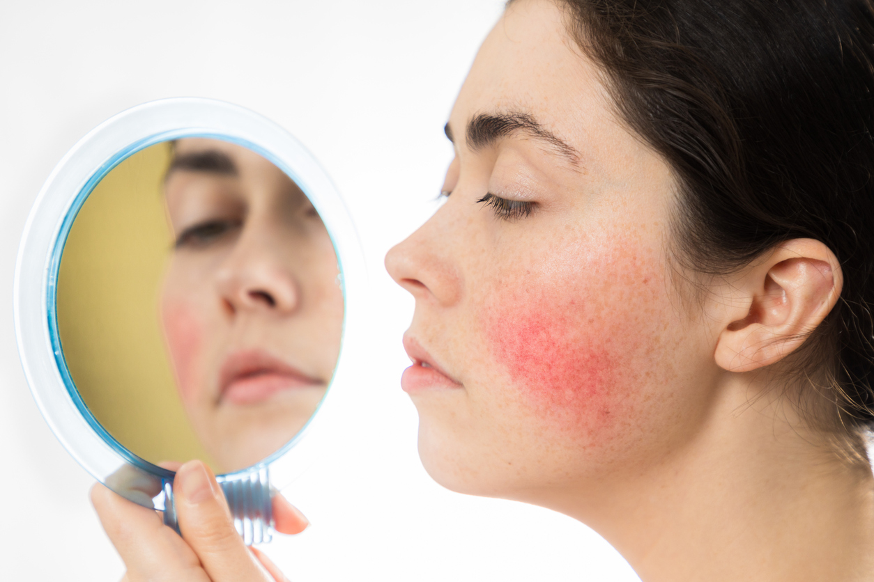 Rosacea: Symptoms and Treatment