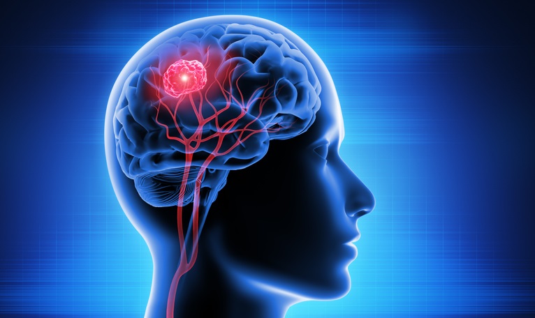 10 Facts About Brain Cancer You Might Not Have Known