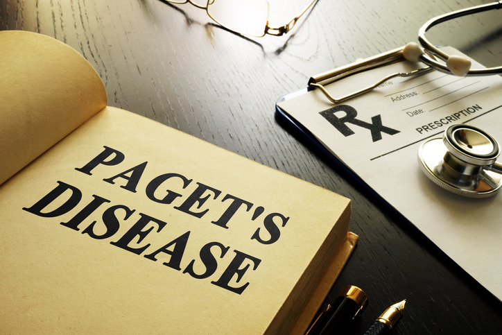 5 Facts About Paget’s Disease